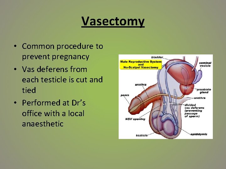 Vasectomy • Common procedure to prevent pregnancy • Vas deferens from each testicle is