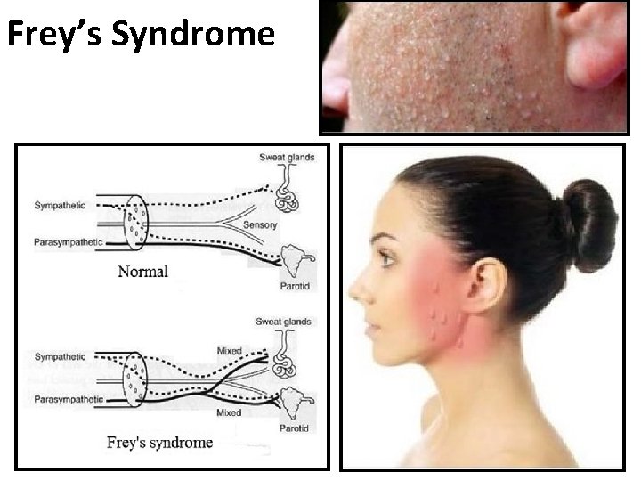 Frey’s Syndrome 
