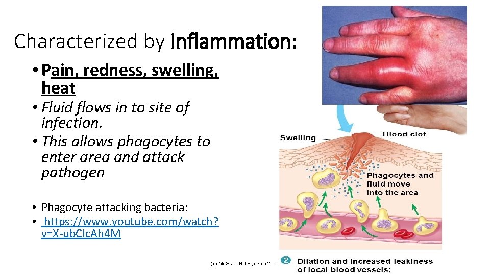 Characterized by Inflammation: • Pain, redness, swelling, heat • Fluid flows in to site