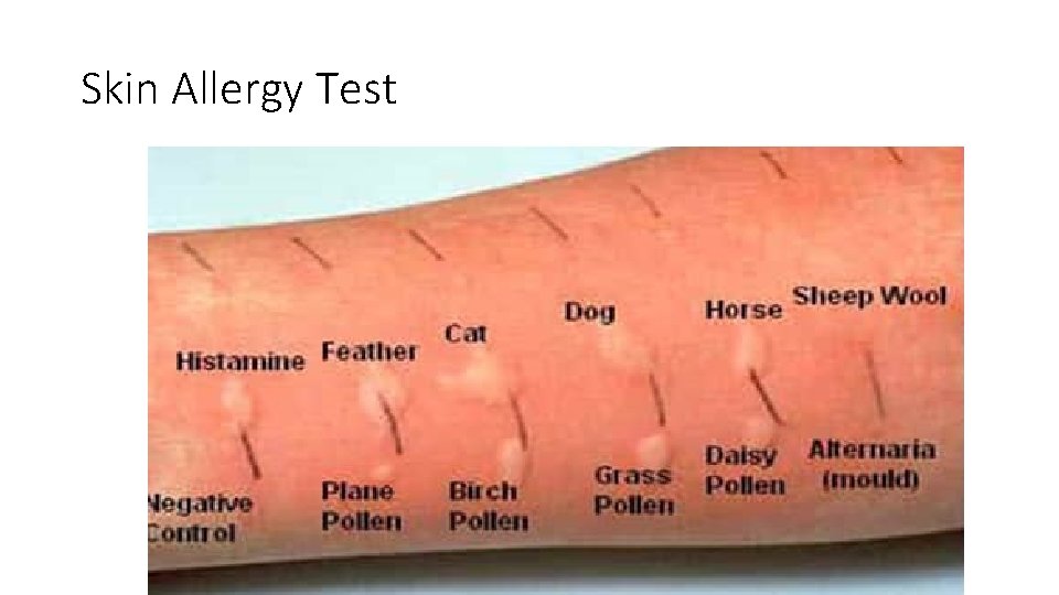 Skin Allergy Test 