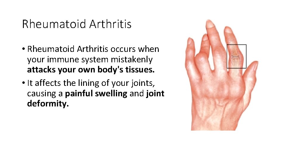 Rheumatoid Arthritis • Rheumatoid Arthritis occurs when your immune system mistakenly attacks your own