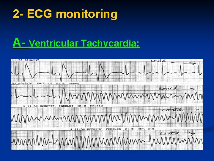 2 - ECG monitoring A- Ventricular Tachycardia: 