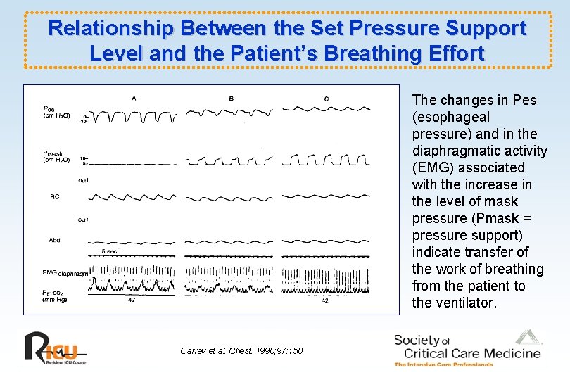 Relationship Between the Set Pressure Support Level and the Patient’s Breathing Effort The changes