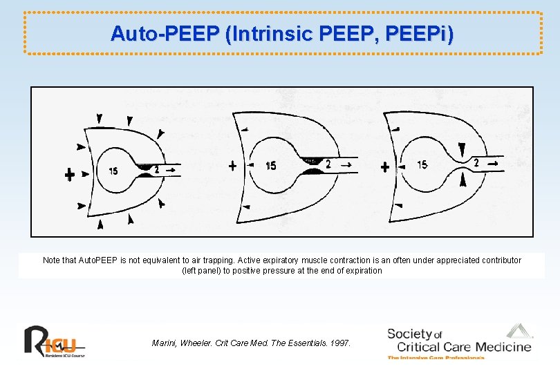 Auto-PEEP (Intrinsic PEEP, PEEPi) Note that Auto. PEEP is not equivalent to air trapping.