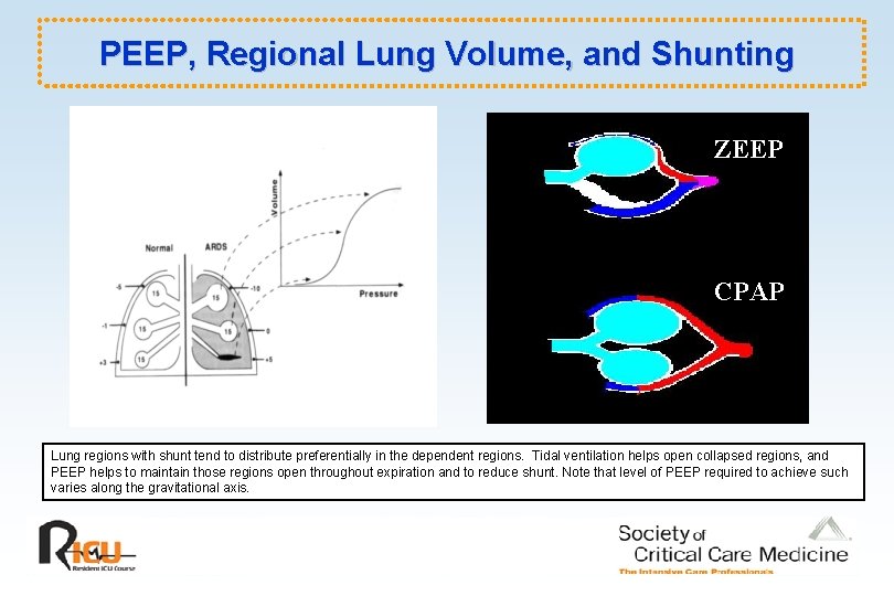 PEEP, Regional Lung Volume, and Shunting ZEEP CPAP Lung regions with shunt tend to