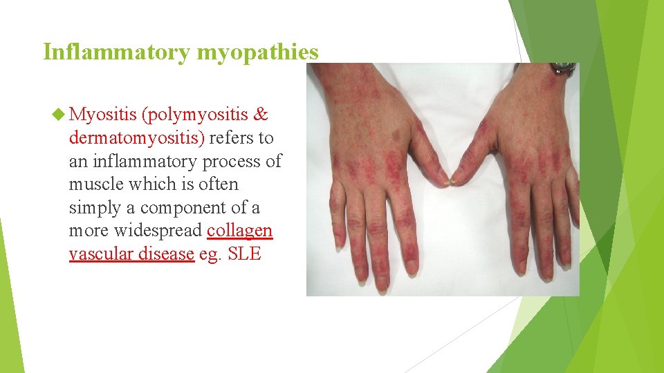 Inflammatory myopathies Myositis (polymyositis & dermatomyositis) refers to an inflammatory process of muscle which