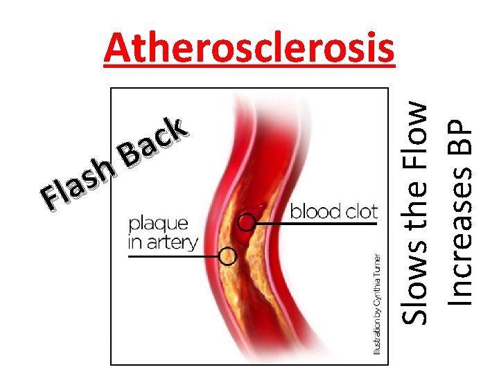 h s a l F k c a B Slows the Flow Increases BP