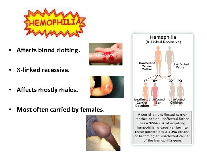  • Affects blood clotting. • X-linked recessive. • Affects mostly males. • Most