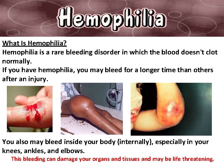 What Is Hemophilia? Hemophilia is a rare bleeding disorder in which the blood doesn't