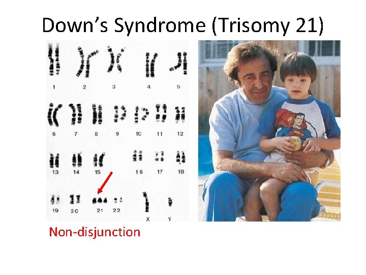 Down’s Syndrome (Trisomy 21) Non-disjunction 