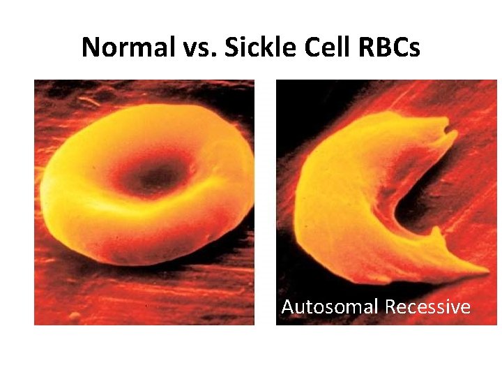 Normal vs. Sickle Cell RBCs Autosomal Recessive 
