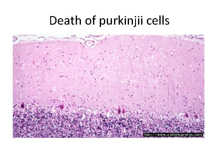Death of purkinjii cells 