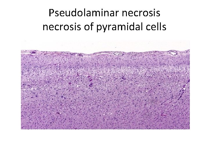 Pseudolaminar necrosis of pyramidal cells 