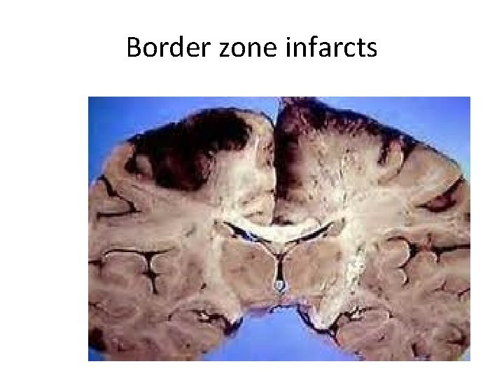 Border zone infarcts 