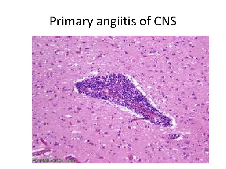 Primary angiitis of CNS 