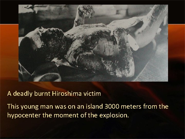 A deadly burnt Hiroshima victim This young man was on an island 3000 meters