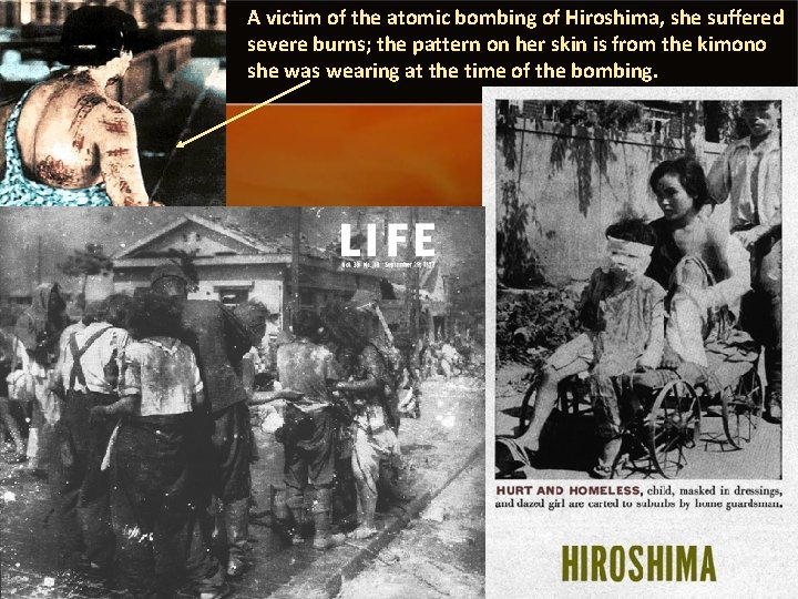 A victim of the atomic bombing of Hiroshima, she suffered severe burns; the pattern
