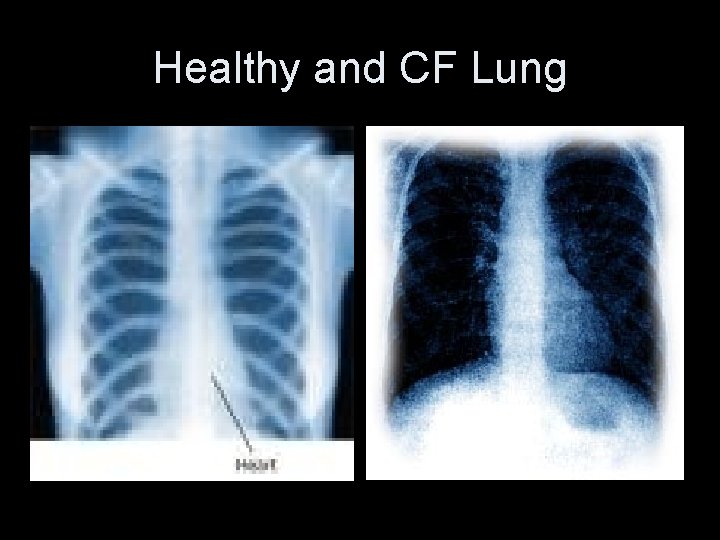 Healthy and CF Lung 