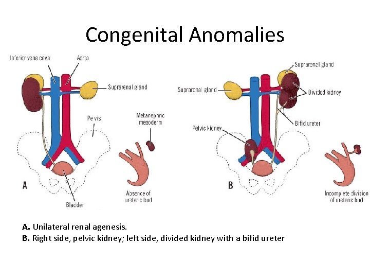 Congenital Anomalies A. Unilateral renal agenesis. B. Right side, pelvic kidney; left side, divided