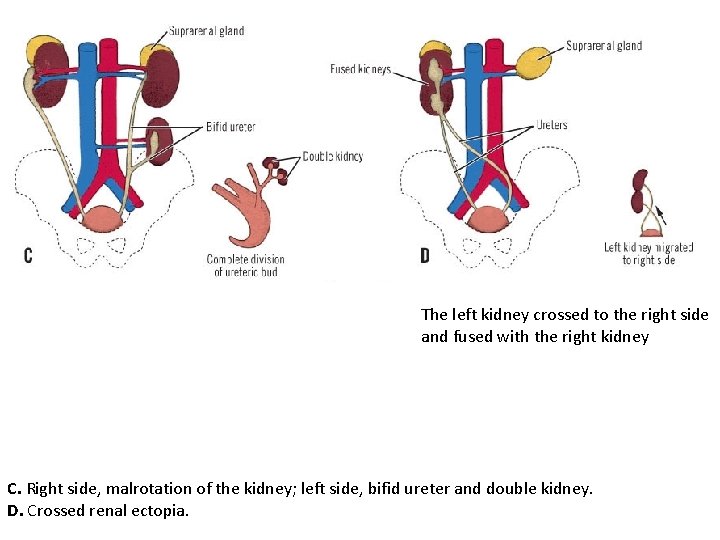 The left kidney crossed to the right side and fused with the right kidney