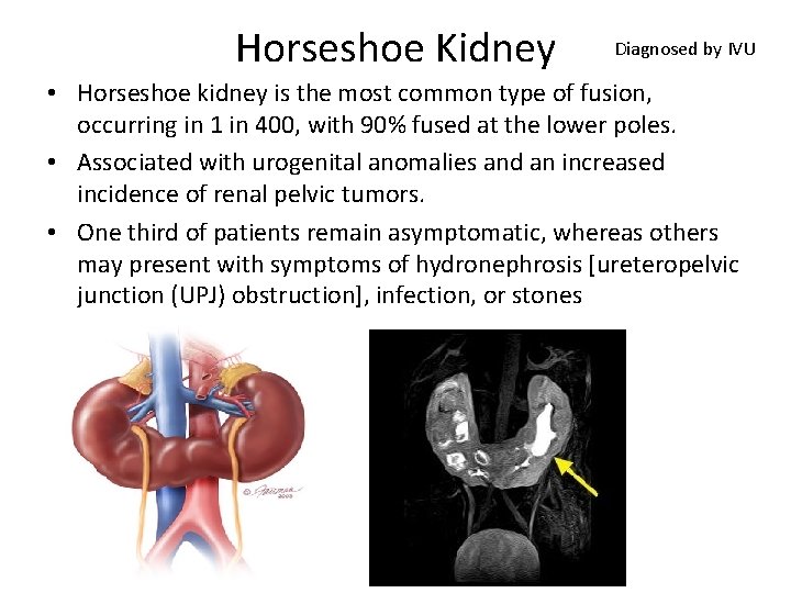 Horseshoe Kidney Diagnosed by IVU • Horseshoe kidney is the most common type of