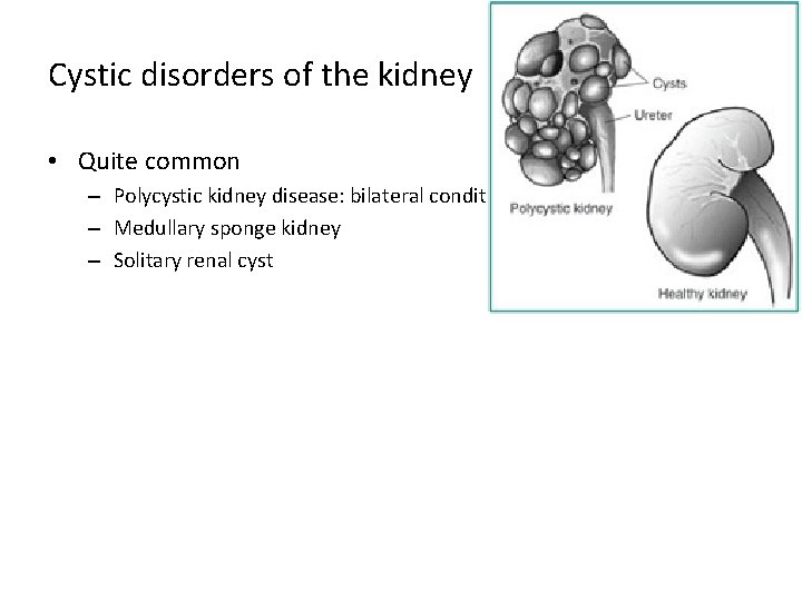 Cystic disorders of the kidney • Quite common – Polycystic kidney disease: bilateral condition