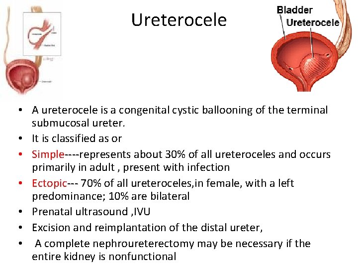 Ureterocele • A ureterocele is a congenital cystic ballooning of the terminal submucosal ureter.