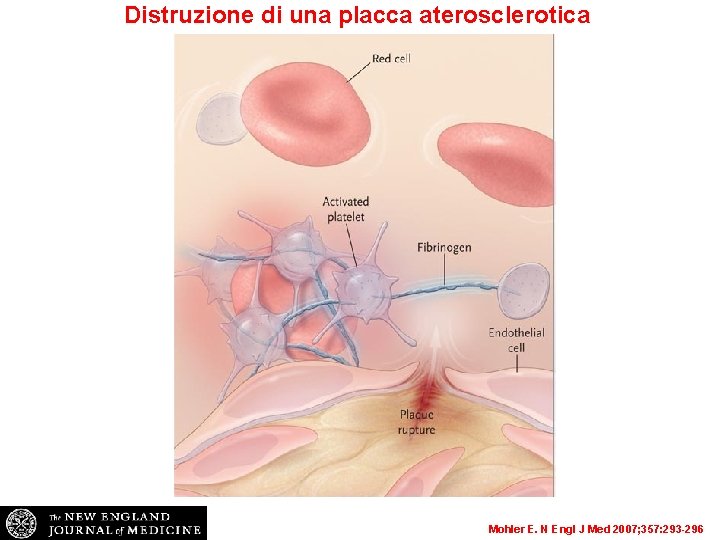 Distruzione di una placca aterosclerotica Mohler E. N Engl J Med 2007; 357: 293