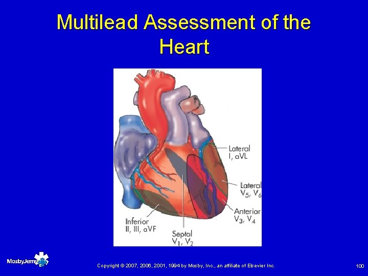 Multilead Assessment of the Heart Copyright © 2007, 2006, 2001, 1994 by Mosby, Inc.
