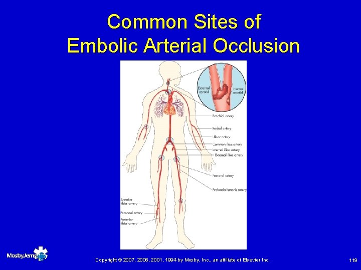 Common Sites of Embolic Arterial Occlusion Copyright © 2007, 2006, 2001, 1994 by Mosby,