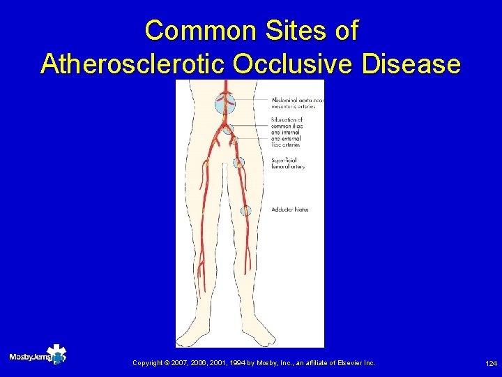 Common Sites of Atherosclerotic Occlusive Disease Copyright © 2007, 2006, 2001, 1994 by Mosby,
