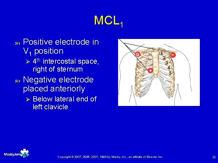MCL 1 Positive electrode in V 1 position Ø 4 th intercostal space, right