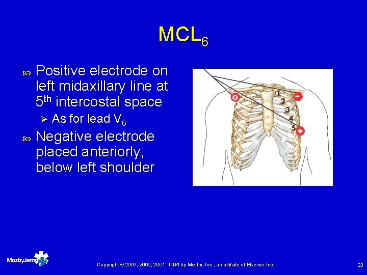 MCL 6 Positive electrode on left midaxillary line at 5 th intercostal space Ø