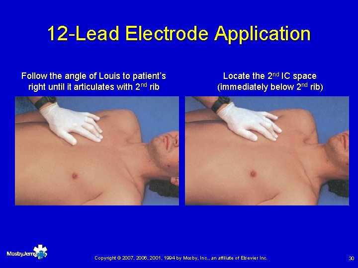 12 -Lead Electrode Application Follow the angle of Louis to patient’s right until it