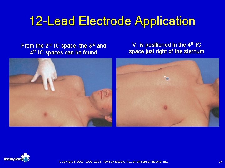 12 -Lead Electrode Application From the 2 nd IC space, the 3 rd and