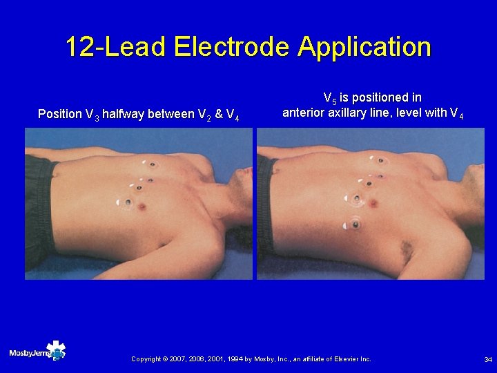 12 -Lead Electrode Application Position V 3 halfway between V 2 & V 4