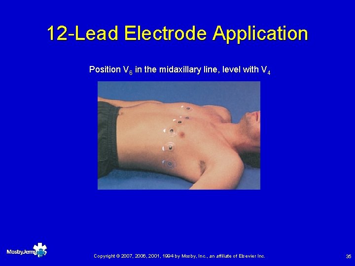 12 -Lead Electrode Application Position V 6 in the midaxillary line, level with V
