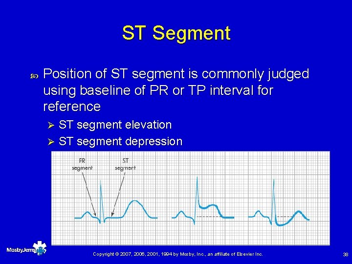 ST Segment Position of ST segment is commonly judged using baseline of PR or