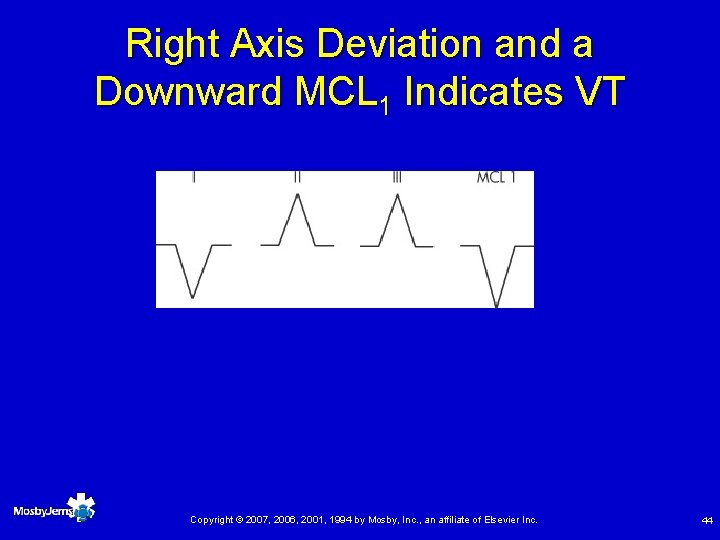 Right Axis Deviation and a Downward MCL 1 Indicates VT Copyright © 2007, 2006,