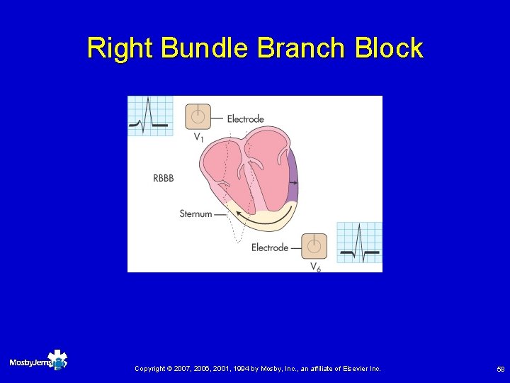 Right Bundle Branch Block Copyright © 2007, 2006, 2001, 1994 by Mosby, Inc. ,