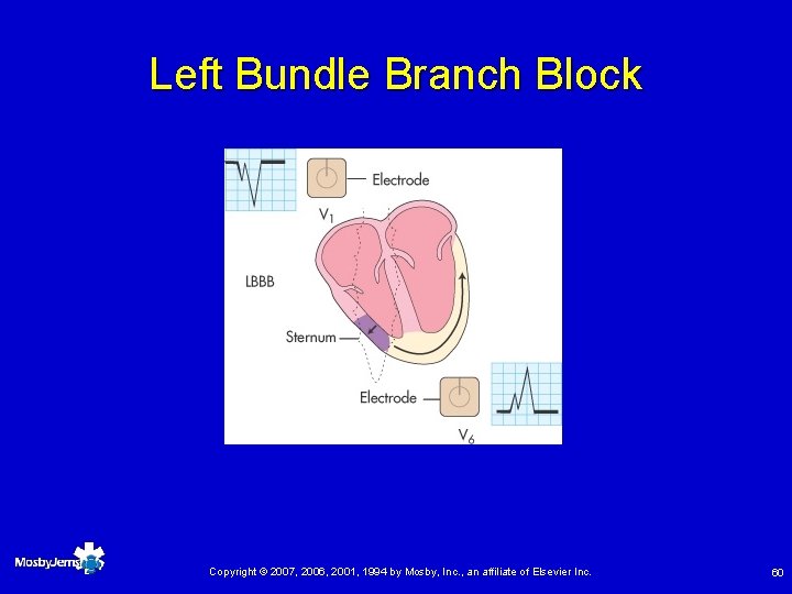 Left Bundle Branch Block Copyright © 2007, 2006, 2001, 1994 by Mosby, Inc. ,