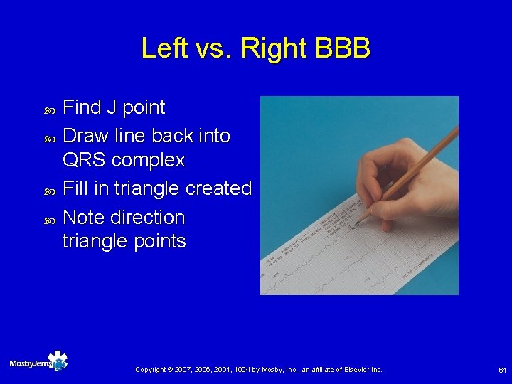 Left vs. Right BBB Find J point Draw line back into QRS complex Fill