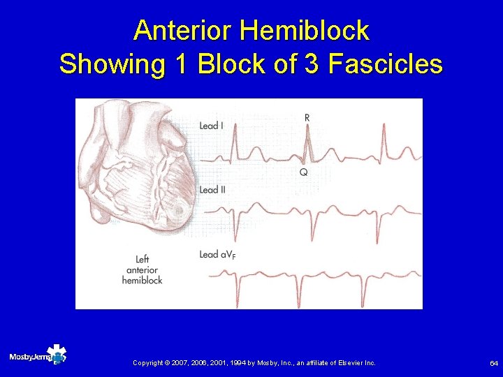 Anterior Hemiblock Showing 1 Block of 3 Fascicles Copyright © 2007, 2006, 2001, 1994