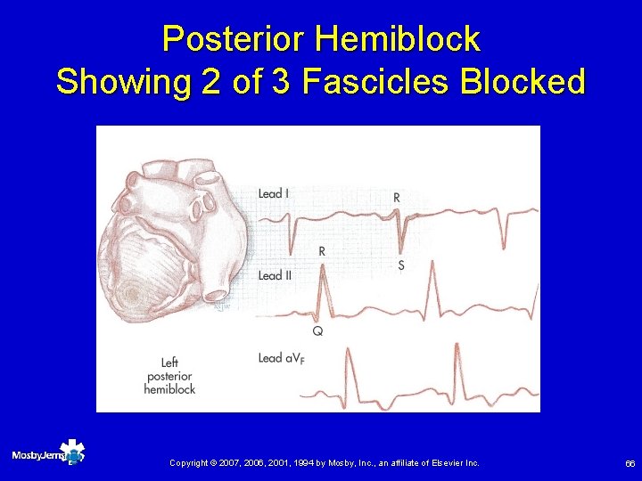 Posterior Hemiblock Showing 2 of 3 Fascicles Blocked Copyright © 2007, 2006, 2001, 1994