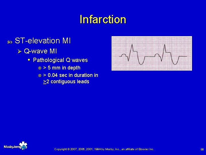 Infarction ST-elevation MI Ø Q-wave MI • Pathological Q waves > 5 mm in