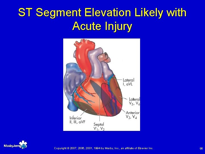 ST Segment Elevation Likely with Acute Injury Copyright © 2007, 2006, 2001, 1994 by