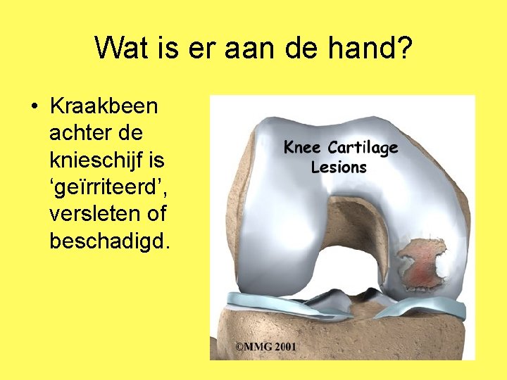 Wat is er aan de hand? • Kraakbeen achter de knieschijf is ‘geïrriteerd’, versleten