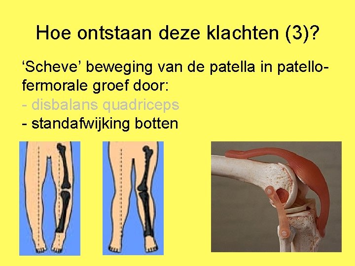 Hoe ontstaan deze klachten (3)? ‘Scheve’ beweging van de patella in patellofermorale groef door: