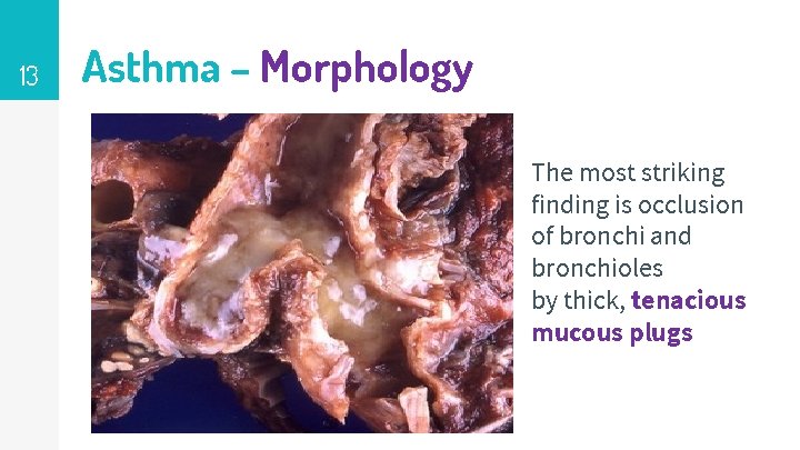 13 Asthma – Morphology The most striking finding is occlusion of bronchi and bronchioles