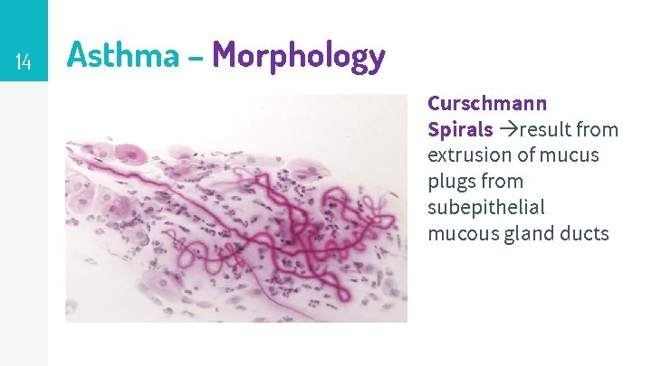 14 Asthma – Morphology Curschmann Spirals result from extrusion of mucus plugs from subepithelial